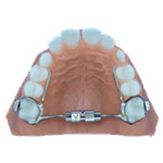 palatal expander